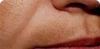 Cloasma o melasma: quali rimedi?