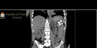 Stazione di Vicenza, arrestato libico con ovuli ingeriti per oltre mezzo chilo di eroina e cocaina in arrivo da Milano