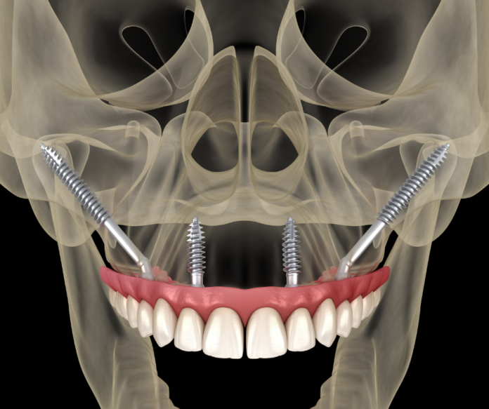 Denti e impianti zigomatici