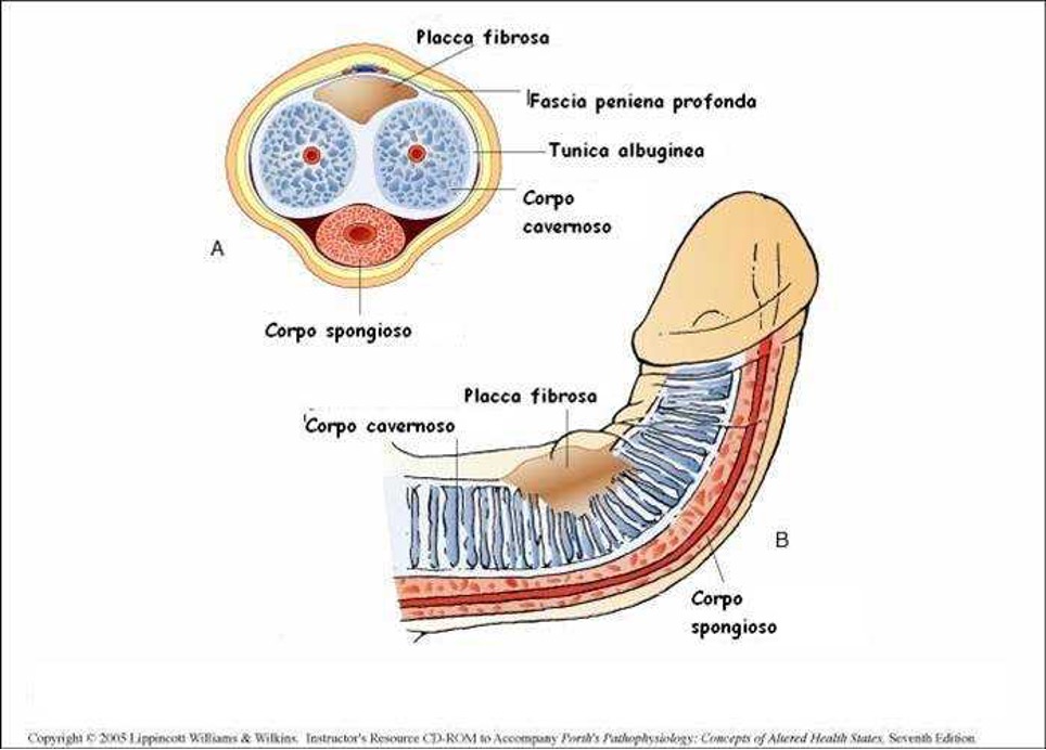 Cause anatomiche della disfunzione erettile