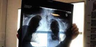 Tumori, Piattaforma polmone per cure personalizzate e diagnosi precoce