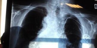 Mesotelioma, l’oncologo Giordano: “In Italia amianto ovunque ma nessuno interviene”