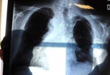 Polmonite, ogni anno in Italia 150mila ricoveri e 9mila morti: i sintomi