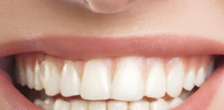 Sorriso ‘social’ perfetto e subito, è boom per le faccette sui denti anche a 14 anni