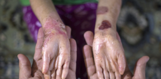 Epidermolisi bollosa, chiude produttore staminali per cure? Luisetto (PD Veneto): “su vicentino Giovanni e bambini “farfalla” Governo si gioca faccia” Epidermolisi bollosa e ragazzi farfalla