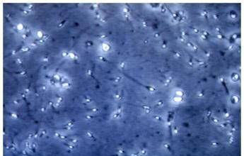 Microplastiche nella prostata e nel liquido seminale, la scoperta italiana: cosa comporta