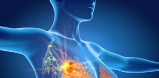 Nuovo cancro seno ereditario, Aiom: “Passo avanti per diagnosi di precisione”