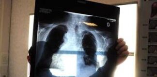 Cancro polmone, scoperta mutazione alleata dell’immunoterapia