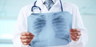 Adenocarcinoma polmonare, svelata carta d’identità della variante mucinosa