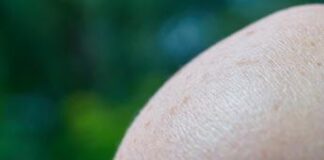 Cos’è il melanoma? Sintomi, prevenzione e successi dell’immunoterapia