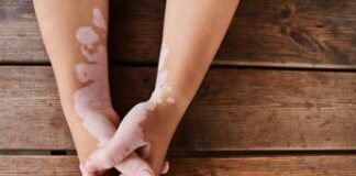 Aifa approva il rimborso per il primo trattamento specifico per vitiligine