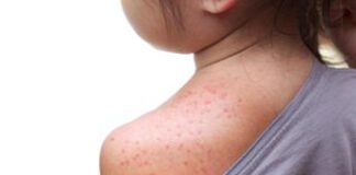 Morbillo, italiani creano database mondiale pubblico con dati aggiornati