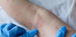 Boom di casi di scabbia, nuova cura risolutiva da antica ricetta: lo studio al Meyer