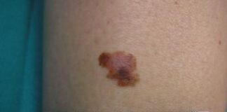 Cancro, oncologo: “Tre anni per vaccino mRna contro melanoma”