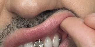 Gioielli sui denti, è grillz mania: possibili rischi