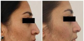 La storia di Pinky, bruciata dal marito e oggi rinata grazie al progetto RigeneraDerma