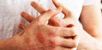 Psoriasi, dopo 4 anni di bimekizumab pazienti con skin clearance completa