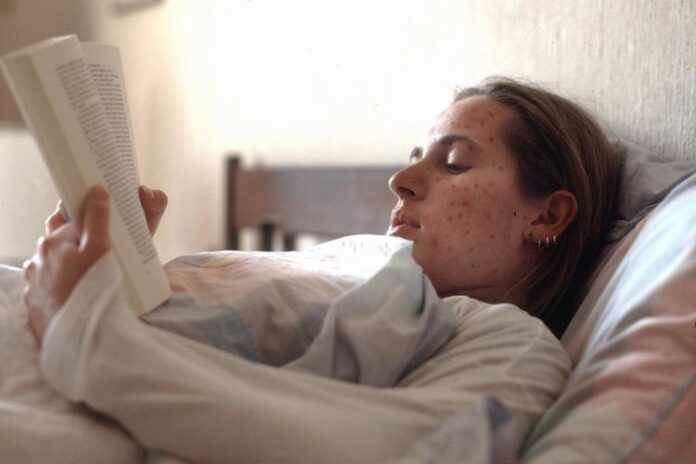 morbillo_ragazza_letto_fg morbillo