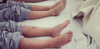 Dal ginocchio valgo al piede piatto, i difetti nei bimbi: cosa fare e quando preoccuparsi