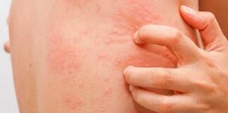 Fake news sull’orticaria, l’immunologo: “Diffidare dai test farlocchi”