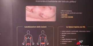 Idrosadenite suppurativa, l’esperto: “Più attenzione a qualità della vita”