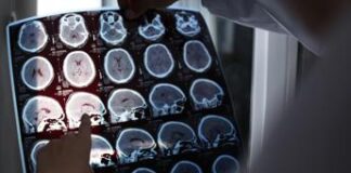L’Alzheimer si eredita? Più rischi se lo ha avuto la mamma: lo studio