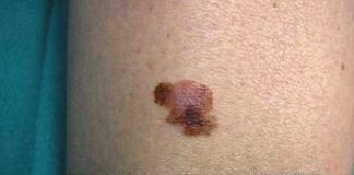 Melanoma, boom nei giovani: è il cancro più comune negli under 30