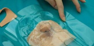 Ricostruito il naso a un bambino grazie alla stampa 3D e al suo fratellino