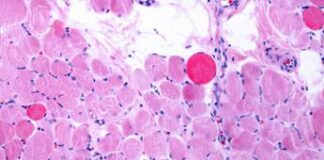 Distrofia Duchenne, via italiana per riparare e rigenerare i muscoli