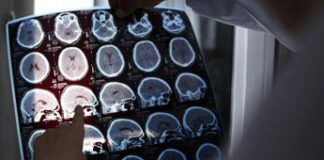 Da test precoci a nuove terapie, corrono studi su Alzheimer