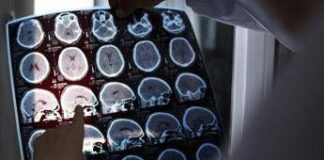 Rallentare l’Alzheimer con il litio, scoperta la ‘scintilla’ che innesca la patologia?