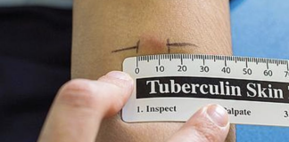 Caso di tubercolosi in operatrice di un centro estivo, ULSS 7 Pedemontana: esami e profilassi per sessanta bambini Tubercolosi di un'operatice centro estivo, subito esami e profilassi