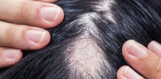Alopecia areata, ok Aifa a rimborsabilità nuovo trattamento