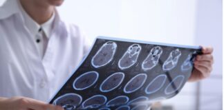 Farmaci, sclerosi multipla: nuovi dati su efficacia a lungo termine per modulatore S1P