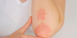 Psoriasi, al via campagna ‘Pausa screening ne vale la pelle’