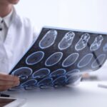 Sclerosi multipla, neurologi: “Con nuovi strumenti la diagnosi sempre più precoce”