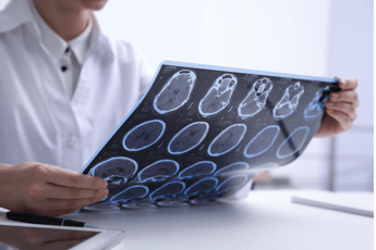 Sclerosi multipla, neurologi: “Con nuovi strumenti la diagnosi sempre più precoce”