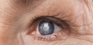 Via cataratta senza operarsi, dal segreto di uno scoiattolo possibile farmaco