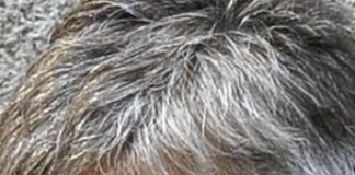 Farmaci: psoriasi cuoio capelluto, nuovi studi confermano efficacia deucravacitinib