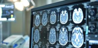 Giornata ictus, neurologi: “Ora un Piano nazionale anche in Italia”