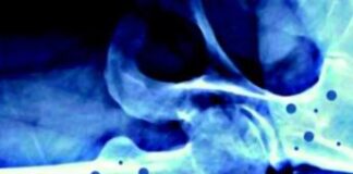 Il 20 ottobre ‘Giornata mondiale dell’osteoporosi’