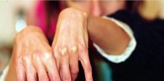 Salute, 3,5 mln italiani con disturbi alimentari, Sipa, ‘centri di cura pochi e mal distribuiti’