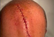 Sangiuliano-Boccia, Report pubblica sui social la foto della ferita alla testa dell’ex ministro