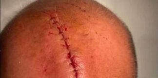 Sangiuliano-Boccia, Report pubblica sui social la foto della ferita alla testa dell’ex ministro