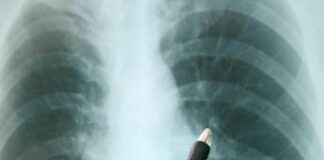 Tbc torna minaccia numero 1, mai così tanti casi: report Oms