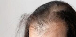 Alopecia areata, Libro bianco e Manifesto per sensibilizzare su patologia