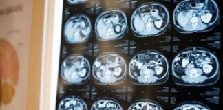 Alzheimer, scoperto in Italia nuovo gene che lo provoca: lo studio