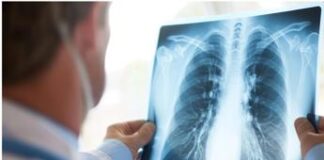 Cancro polmone, firma molecolare predice efficacia immunoterapia