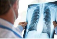 Curare il cancro al polmone senza chirurgia, prima italiana all’Ieo di Milano