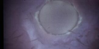 Infertilità maschile, trovati batteri in liquido seminale che ‘tagliano’ spermatozoi